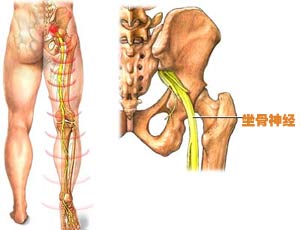 坐骨神经痛的症状（坐骨神经痛的症状在哪个部位）