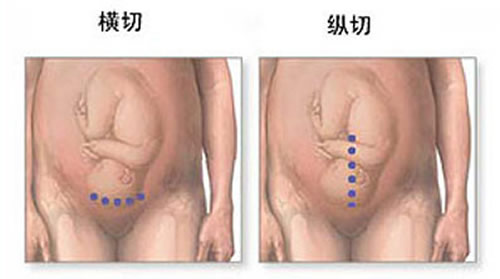 剖腹产横切还是竖切好 剖腹产横切还是竖切好恢复身材