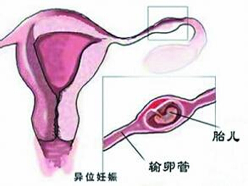 宫外孕是怎么引起的（女生宫外孕是怎么引起的）