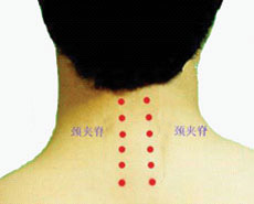 颈椎病针灸穴位图 颈椎病针灸部位图解