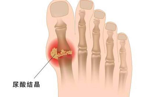 尿酸不高了脚趾关节痛 脚关节疼尿酸不高