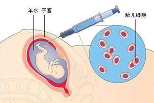 羊水穿刺什么时候做（高龄羊水穿刺什么时候做）