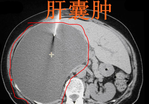 肝囊肿是怎么回事（肝囊肿是怎么回事?有危险吗）