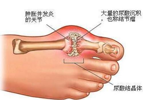 痛风用什么泡脚最好 痛风用什么泡脚最好,用小苏打水泡痛风处好吗