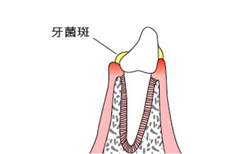 牙周炎是什么原因引起的 慢性牙周炎是什么原因引起的