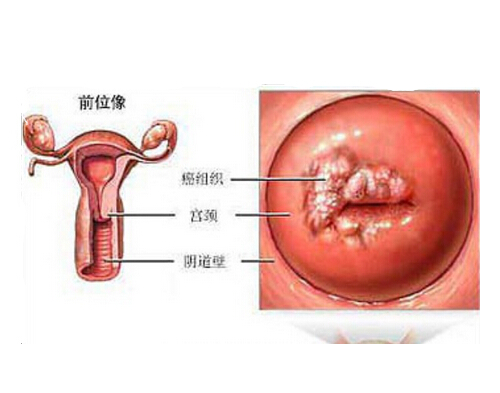 hpv病毒是什么 hpv病毒是什么症状