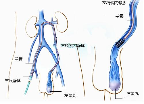 老怀不上竟是因为精索静脉曲张 精索静脉曲张是不是绝对怀不了孩子