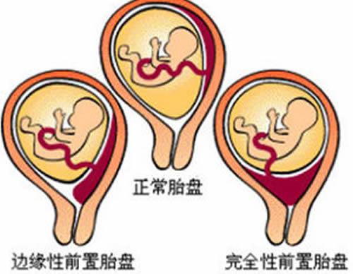 前置胎盘是怎样造成的 前置胎盘是怎样造成的呢