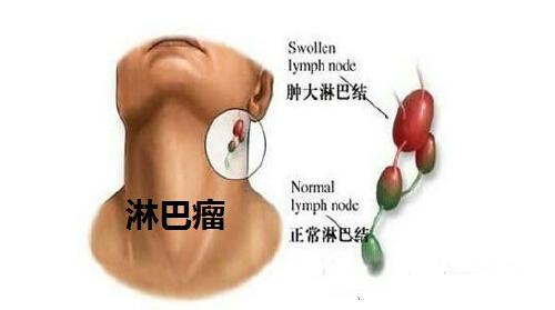 肺癌究竟是如何转移的（肺癌是怎么转移的）