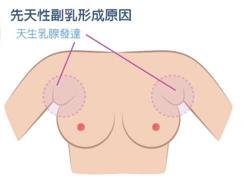 副乳的危害 男性副乳的危害