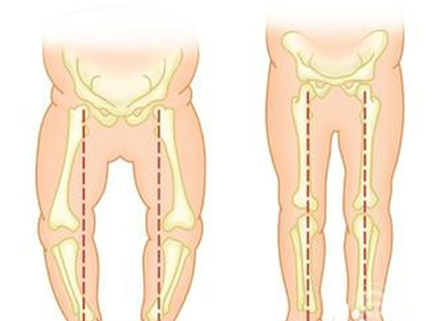 婴儿O型腿如何判断 婴儿o型腿如何判断图片