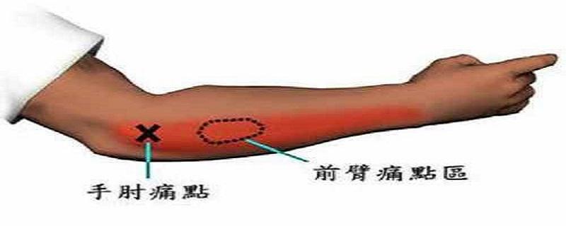 网球肘艾灸要哪个位置（网球肘灸哪里）