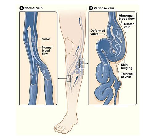 下肢静脉曲张有什么危害 下肢静脉曲张有哪些危害