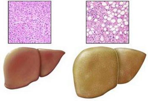 脂肪肝的危害及防治（脂肪肝危害性）