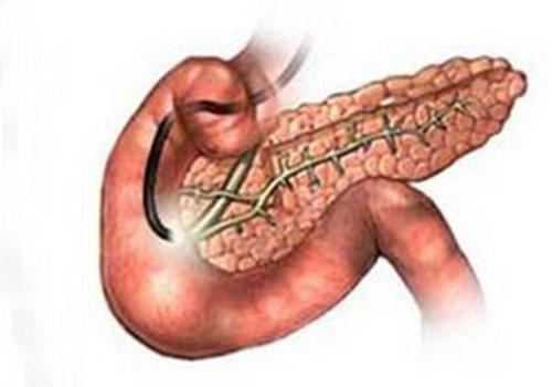 急性胰腺炎的治疗方法 急性胰腺炎的治疗方法和预后恢复情况如何