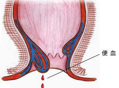 产后便血怎么回事 产后老是便血怎么办