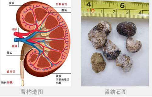 肾结石需要做手术吗（肾积水肾结石需要做手术吗）