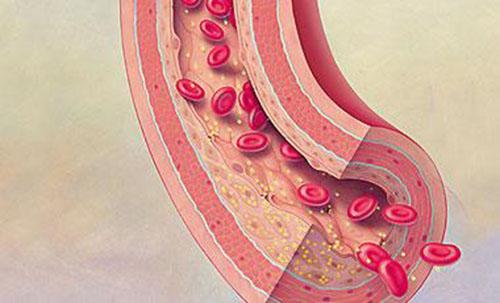 早期血栓症状有哪些 早期血栓的症状有哪些