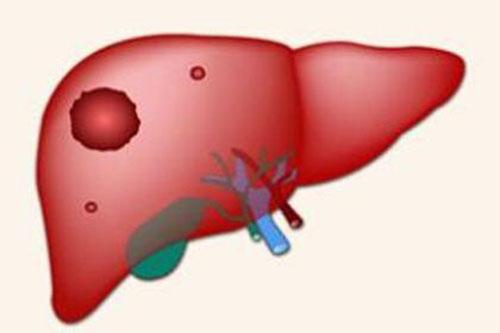 肝癌有哪些典型的症状（肝癌的典型症状是什么）