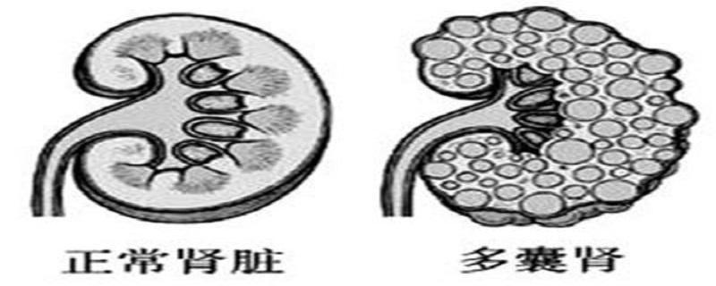 多囊肾怎么检测出来（多囊肾通过什么查出来）