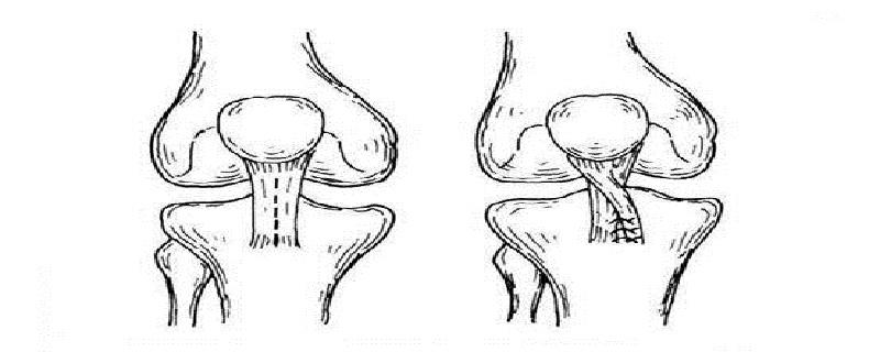 髌骨半脱位的原因 髌骨脱位和半脱位