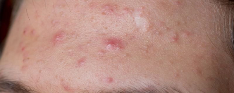 脸上长粉刺怎么办 脸上长粉刺该如何解决