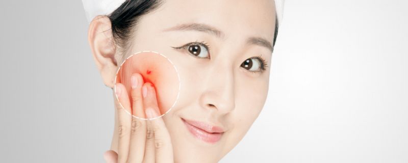 十滴水可以祛痘吗 十滴水有没有祛痘效果