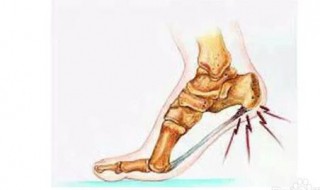 足跟痛症的防治 足跟痛应该怎么防治