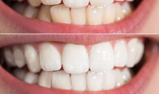 几月几日是国际爱牙日 关于几月几日是国际爱牙日