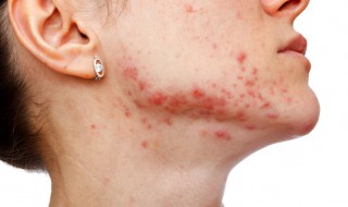 脸上红印怎么去除 脸上红印怎么去除小妙招