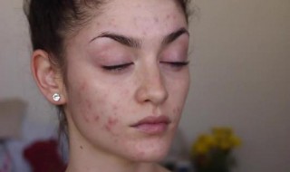 痘痘肌怎么护肤（痘痘肌护肤品）