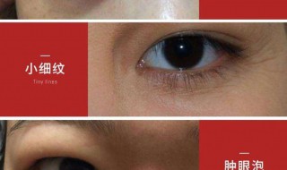 黑眼袋怎么去除 黑眼袋怎么去除最有效果