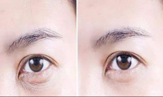 怎么去掉鱼尾纹 怎么去掉鱼尾纹皱纹