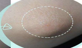 手肘皮肤粗糙解决方法