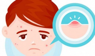 祛痘的方法（有什么祛痘的方法）