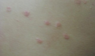 梅毒是什么 梅毒是什么病,怎么引起的