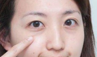 泪沟是什么 泪沟是什么原因引起的怎么办