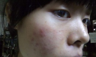 青春痘如何去除（少年脸上的青春痘如何去除）