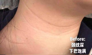 去颈纹最有效的方法 去颈纹最有效的方法开塞露