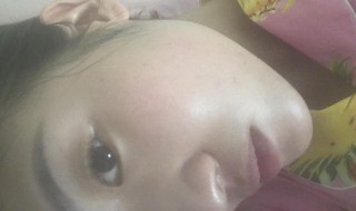 痘痘怎么去除效果好（背后有痘痘怎么去除效果好）