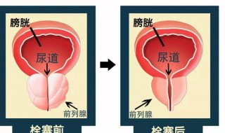 前列腺是什么（前列腺是什么部位图片）