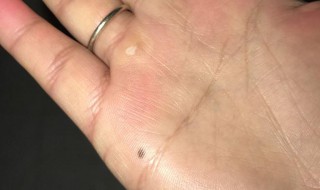 黑痣的意思 黑痣有什么讲究