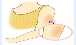 前胸后背长痘痘是什么原因 怀孕前胸后背长痘痘是什么原因