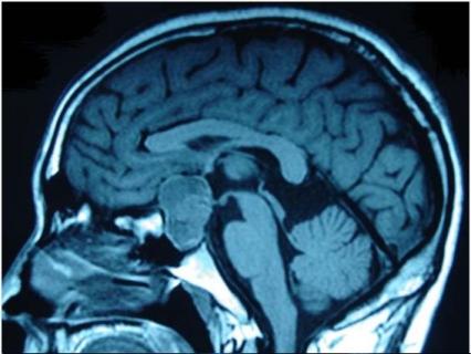 松果体囊肿常见吗 松果体囊肿普遍吗