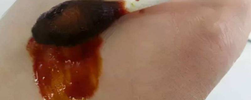 碘酒怎么洗掉（床单上的碘酒怎么洗掉）