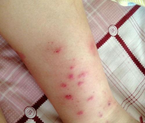 荨麻疹严重吗 荨麻疹严重吗有什么危害