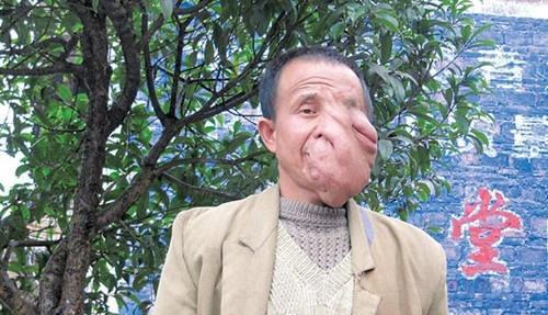 神经性纤维瘤（神经性纤维瘤图片）