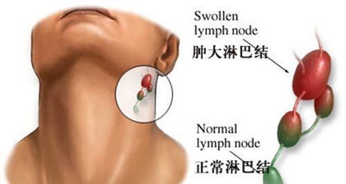 淋巴结肿大的偏方（消除颈部淋巴结肿大的偏方）