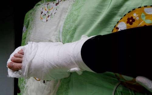 骨裂的康复时间 骨裂的康复时间是多长轻微