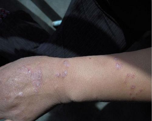 银屑病的治疗方法